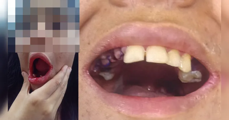 Estado apura caso de jovem autista que teve 17 dentes extraídos sem autorização da família