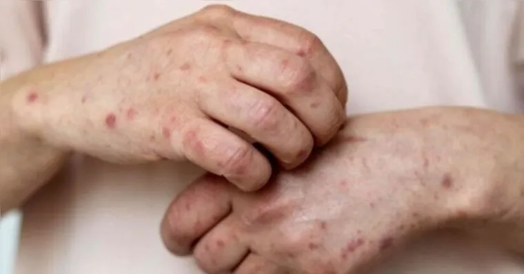 As lesões cutâneas representam o principal sinal clínico da mpox. O processo de evolução dessas marcas segue etapas bem definidas. | Reprodução / Freepik