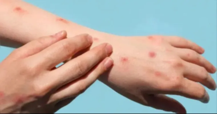 Alerta de casos de mpox continua no Brasil | Reprodução