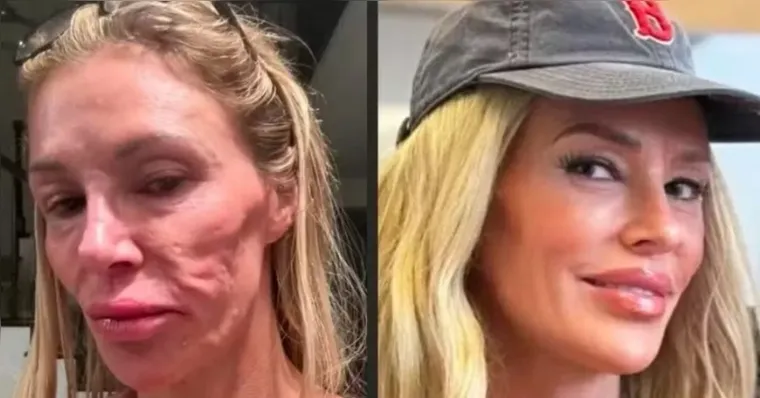 Antes e depois das cirurgias foram mostrados pela influenciadora | Reprodução / Redes Sociais