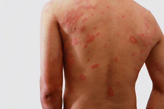 Canaã inicia ações de prevenção à hanseníase nesta quinta (19)